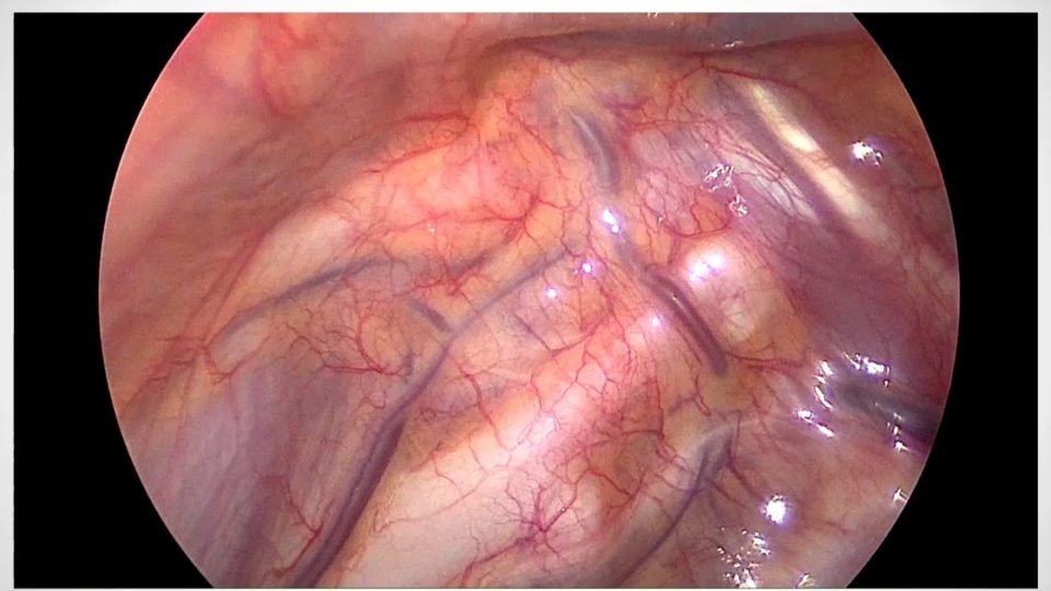 Sympathectomie thoracique endoscopique