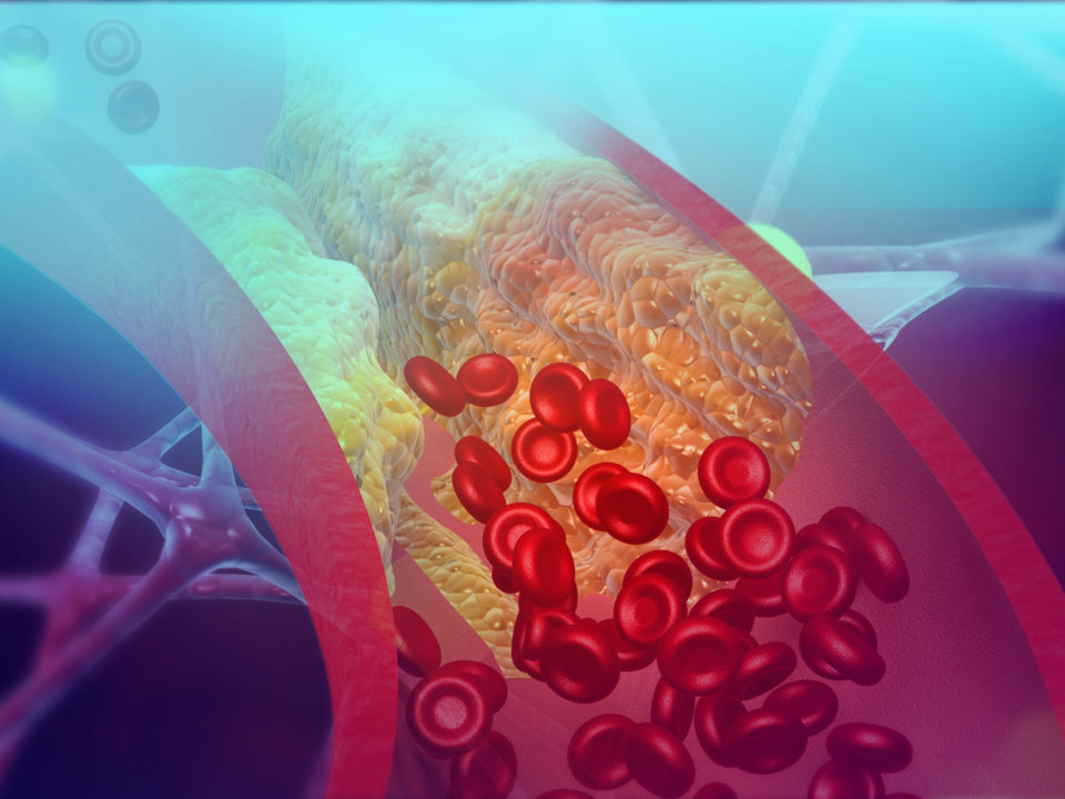 Hypercholesterolemie-familiale