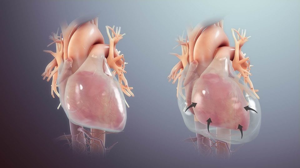 Tamponnade cardiaque