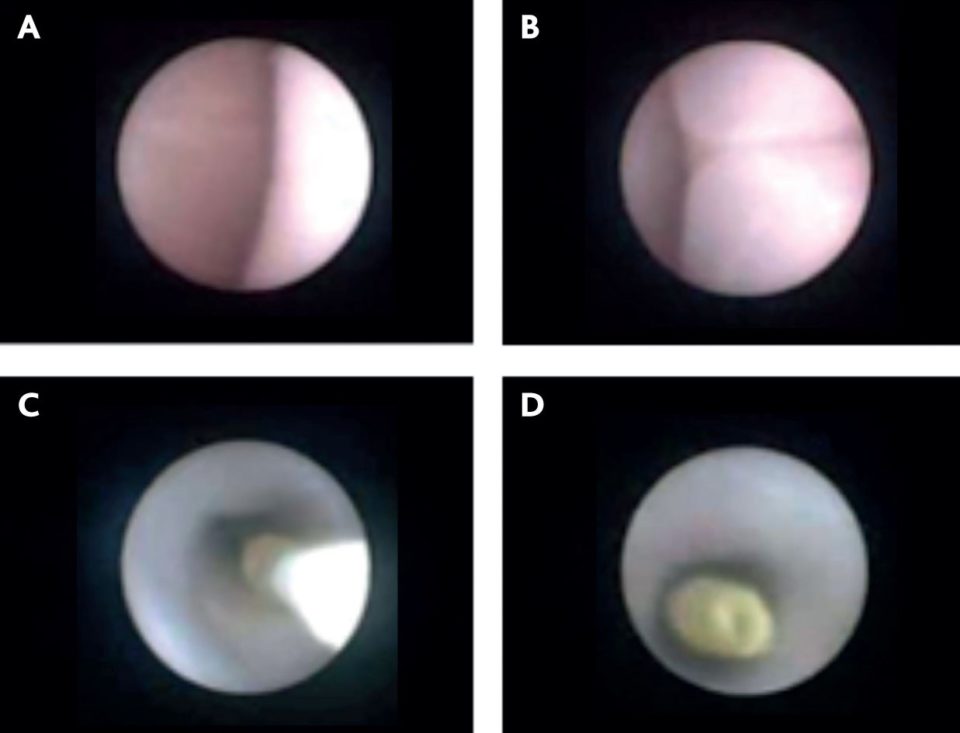 Hernie diaphragmatique