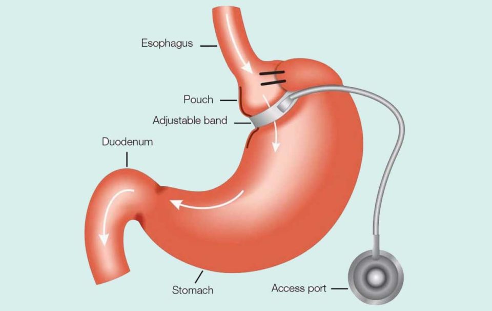 Gastroplastie par laparoscopie